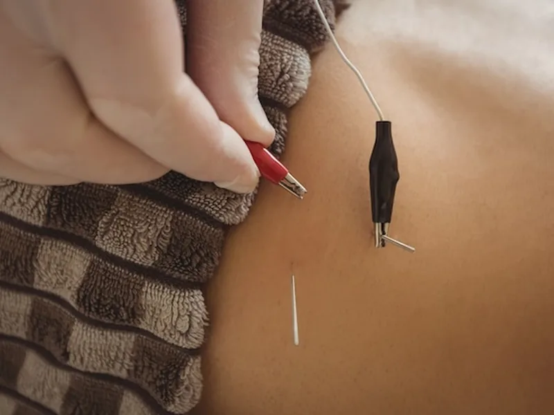 Dry Needling at Maritime Physical Therapy in Plymouth, MA
